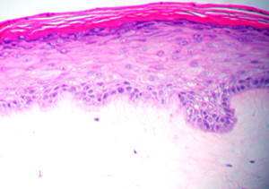 close up view of histology of Psoriasis human tissue model